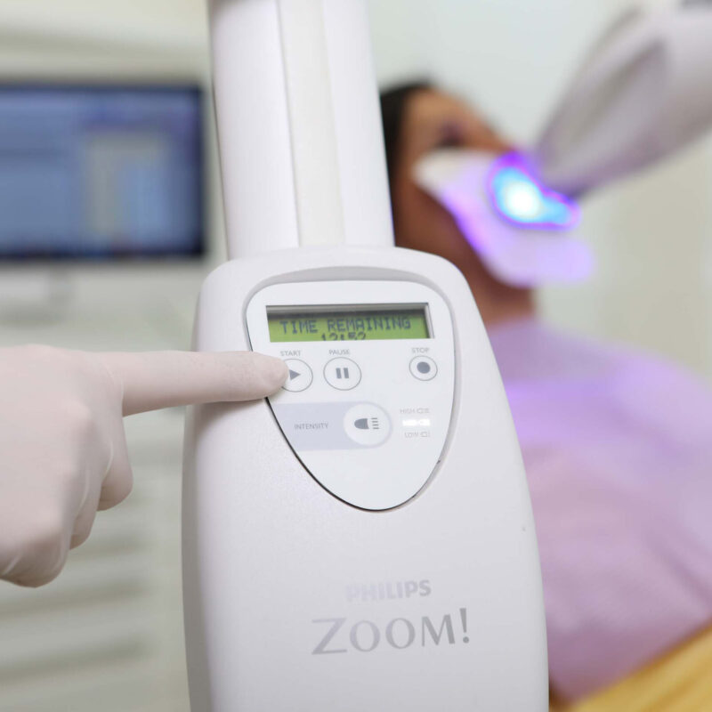 Zahnaerzte_am_Augustaplatz_Bleaaching_Zahnaufhellung_Kachel