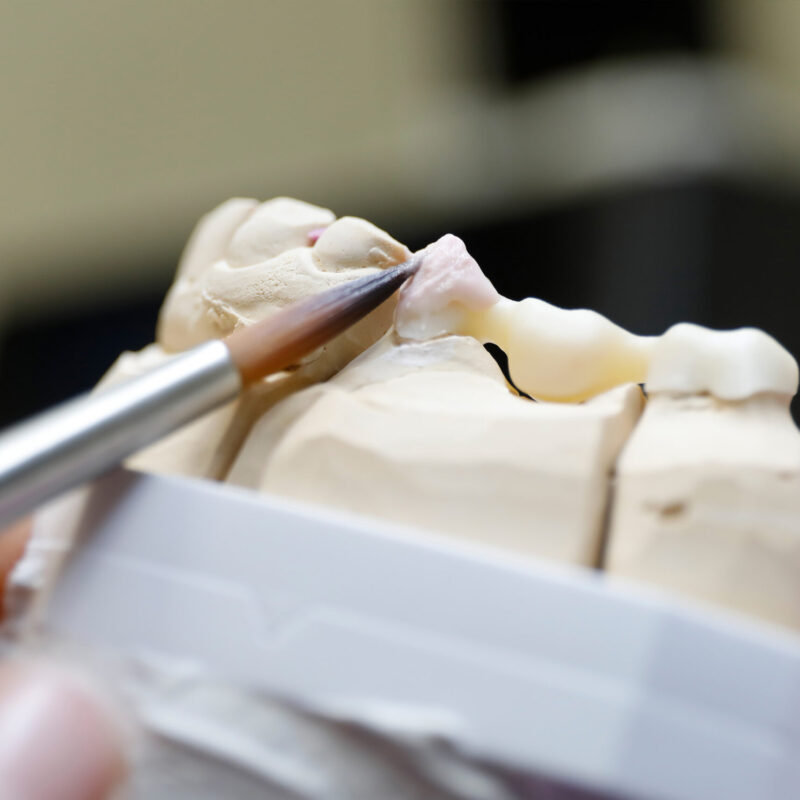 Zahnaerzte_am_Augustaplatz_Vollkeramischer_Zahnersatz_Kachel