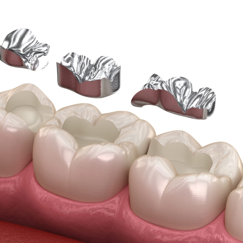 Zahnaerzte_am_Augustaplatz_Amalgamsanierung_Kachel